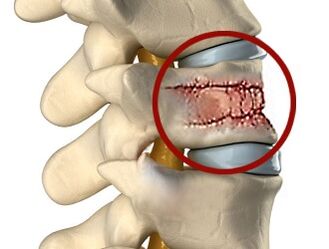 Nugaros skausmo priežastys gali būti stuburo ir tarpslankstelinių diskų ligos. 