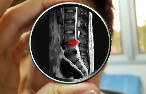 Apatinės nugaros dalies skausmo ignoravimo pasekmė gali būti disko išvarža. 