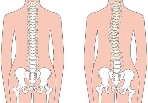 Nugaros skausmas dėl stuburo deformacijos, pvz., skoliozė