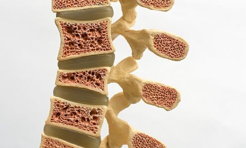 Osteoporozė yra viena iš apatinės nugaros dalies skausmo priežasčių