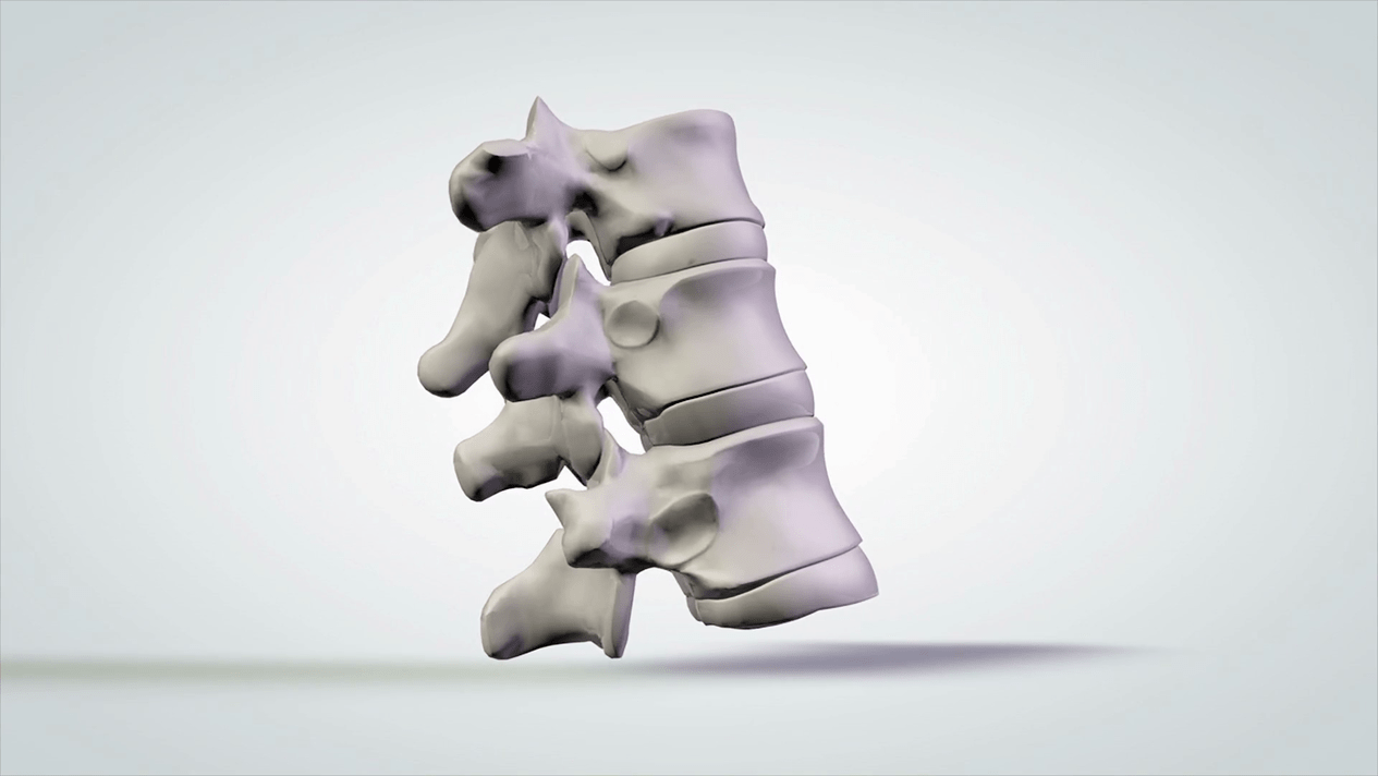 stuburo pažeidimas dėl gimdos kaklelio osteochondrozės