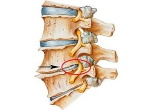 Osteochondrozės požymiai ir simptomai