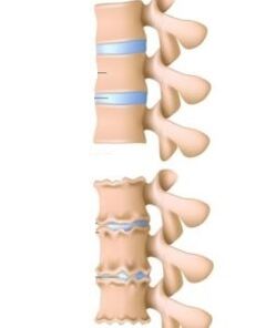 Osteochondrozės priežastys